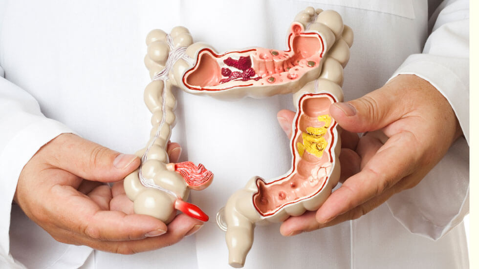 Cancerul de colon: cauze, simptome, tratament